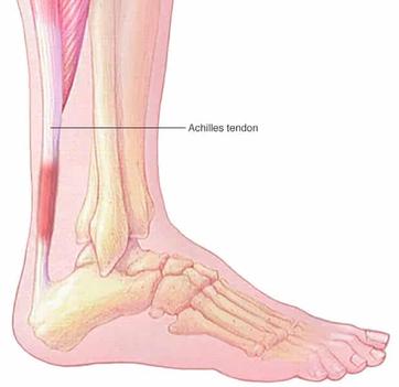 Best Tennis Shoes For Achilles Tendonitis - 5 Shoes to Play Pain-Free